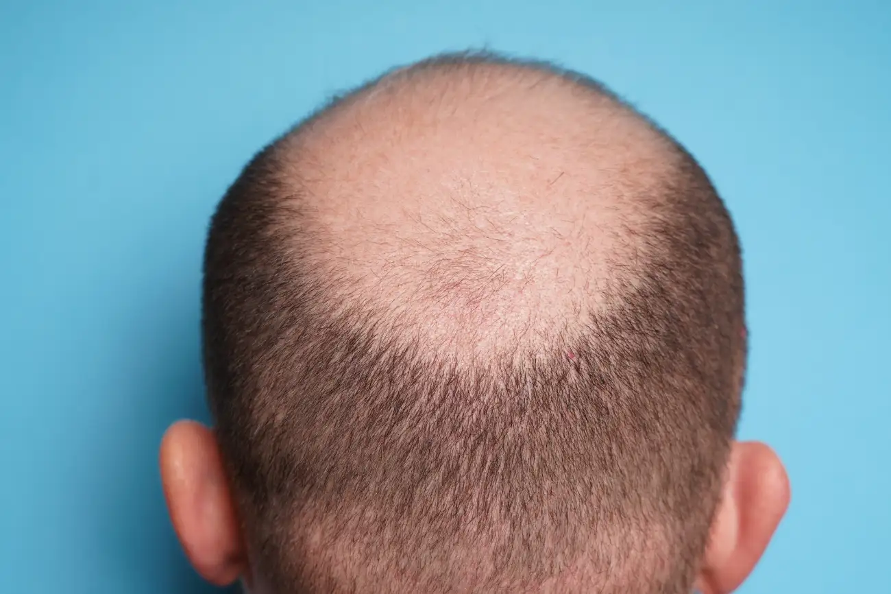 calvizie o alopecia androgenetica