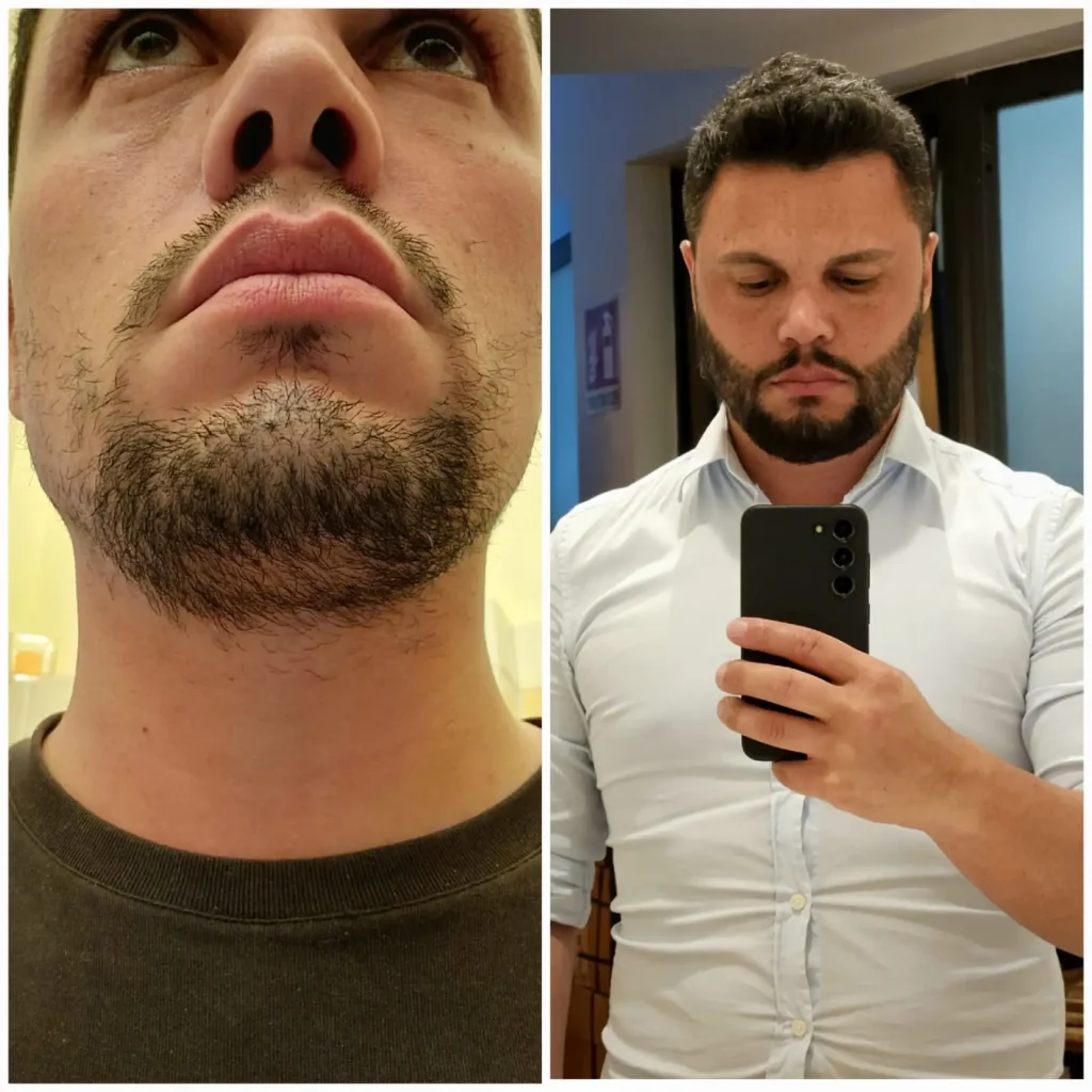 prima e dopo trapianto barba