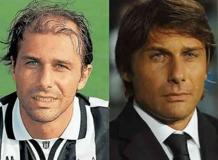 Antonio Conte prima e dopo il trapianto di capelli 2