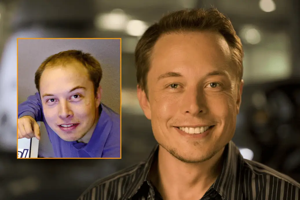 Elon Musk trapianto capelli