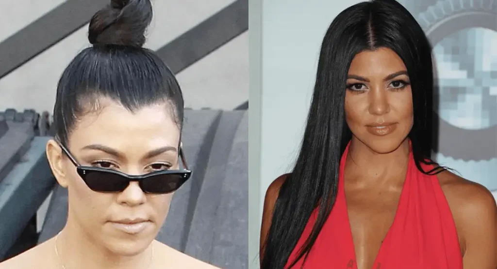 Kardashian trapianto capelli