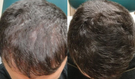 risultati laserterapia capelli