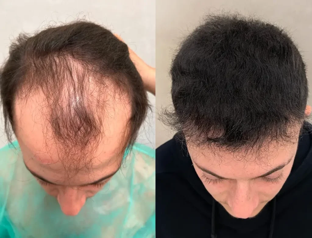 testimonianza trapianto capelli naturali