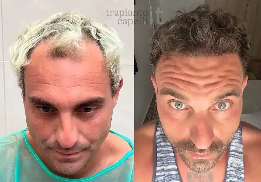 risultato infoltimento capelli 1