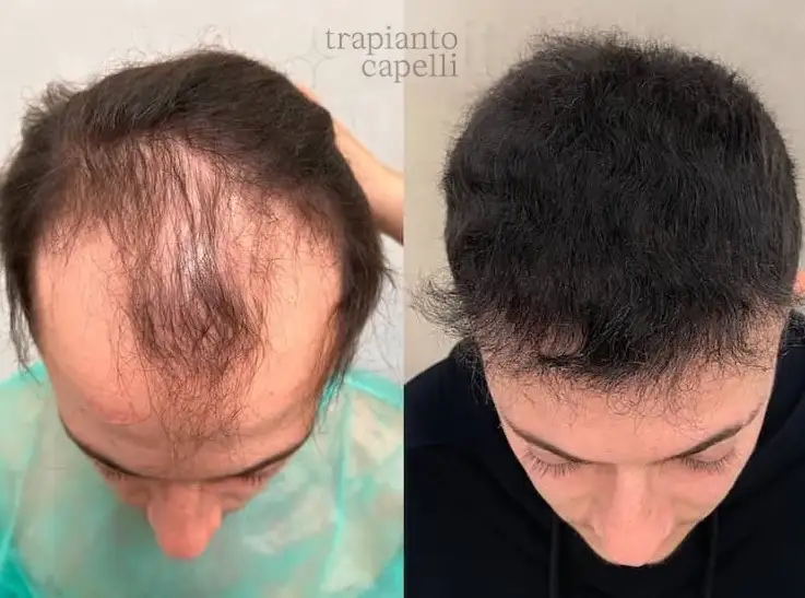 risultato trapianto capelli prima e dopo 4