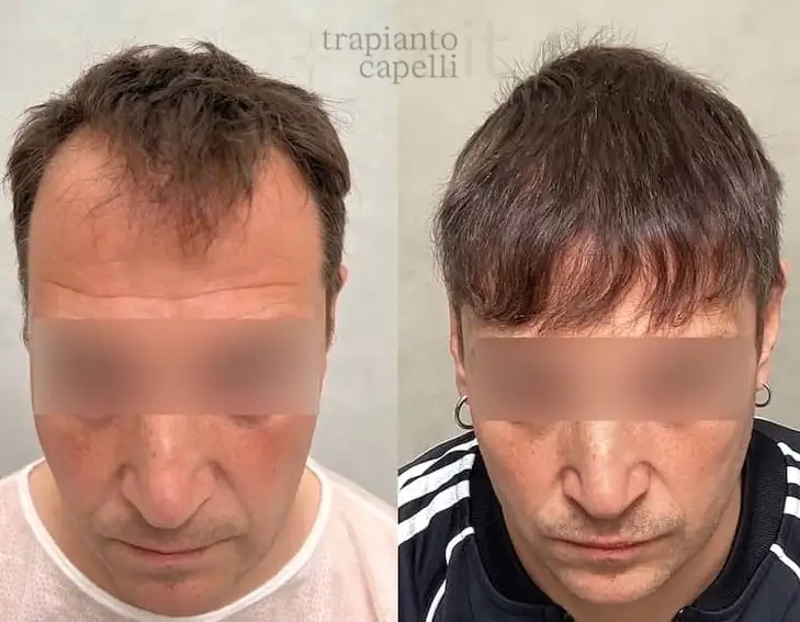risultato trapianto capelli prima e dopo 1