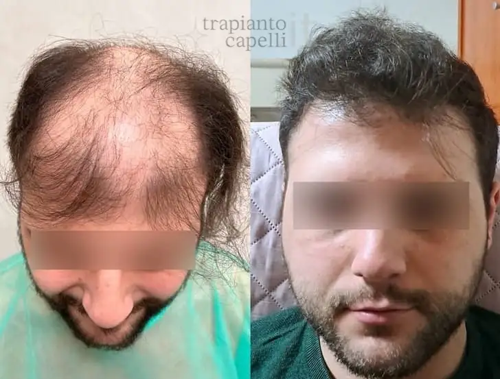 risultato trapianto capelli prima e dopo 5