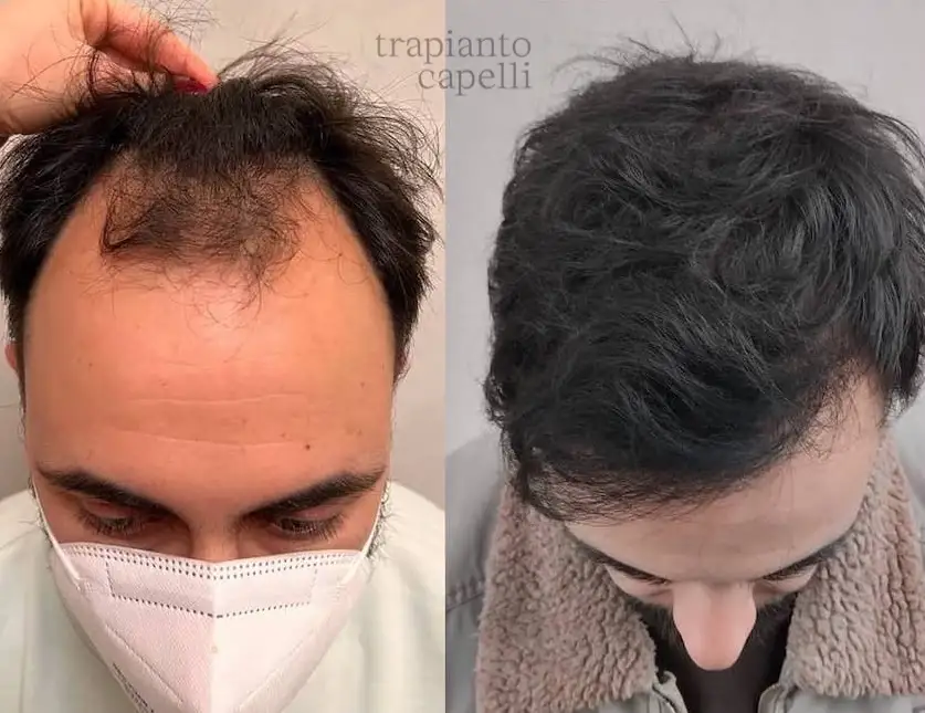 risultato trapianto capelli prima e dopo 7
