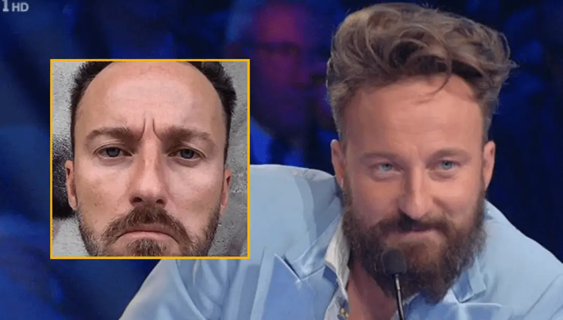 Francesco Facchinetti trapianto capelli