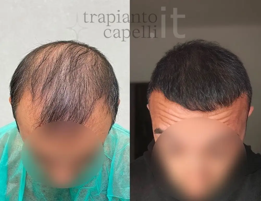 trapianto capelli guarda i risultati